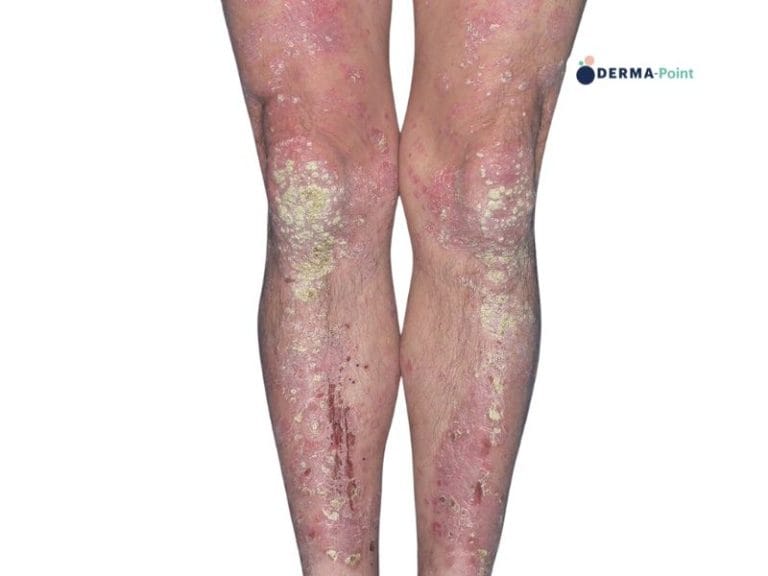 Ppsoriasi: placche eritemato-desquamative escoriate sulle gambe
