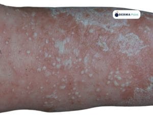 Psoriasi pustolosa con cute arrossata