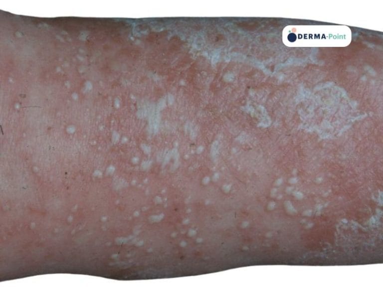 Psoriasi pustolosa con cute arrossata