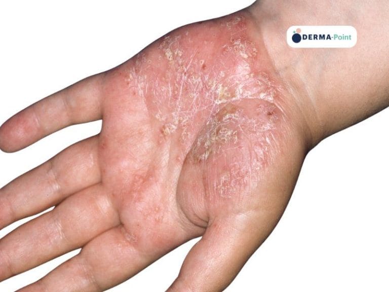 Psoriasi pustolosa palmare