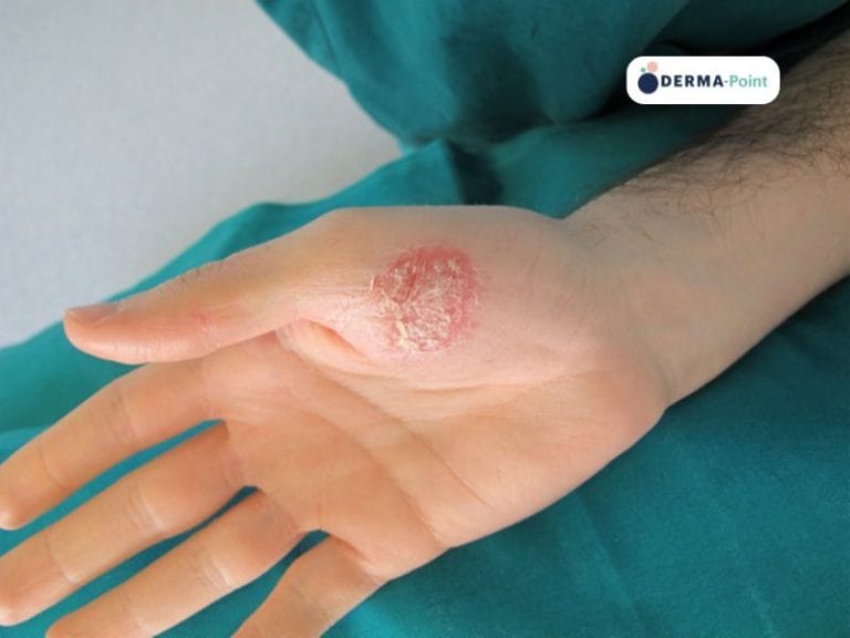 Psoriasi pustolosa palmare in giovane adulto