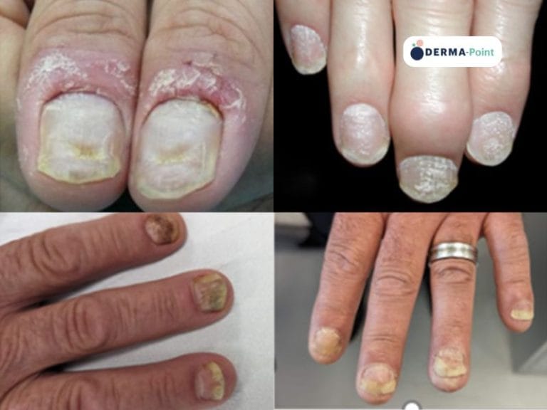 Psoriasi ungueale (dita delle mani)