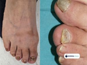 Psoriasi ungueale (dita dei piedi)