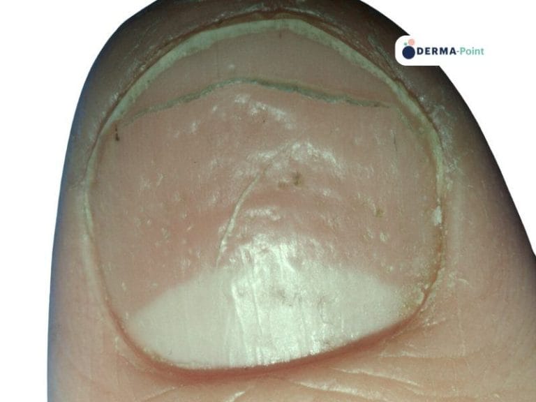 Psoriasi ungueale con pitting