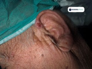 Carcinoma squamocellulare su cheratosi attinica