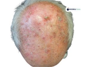 Cheratosi attinica del cuoio capelluto