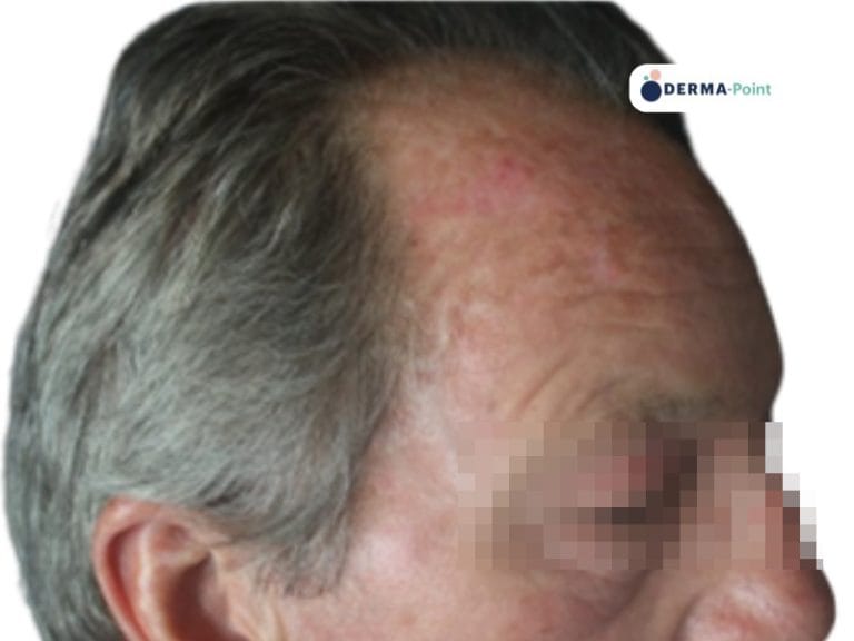 Cheratosi attinica sulla fronte