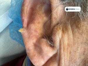 Cheratosi attinica ipertrofica