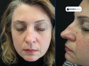 Cheratosi attinica sul naso