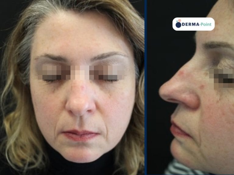 Cheratosi attinica sul naso