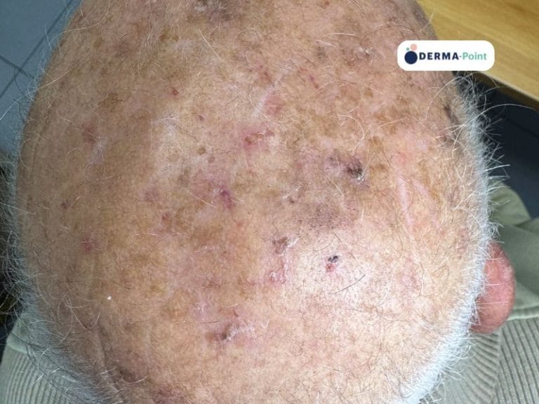 Cheratosi attiniche multiple