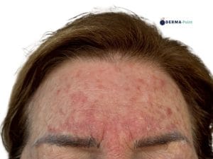 Cheratosi attiniche multiple in sede frontale