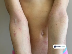 Dermatite atopica con eczema flessurale