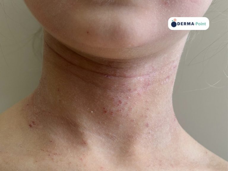 Dermatite atopica sul collo