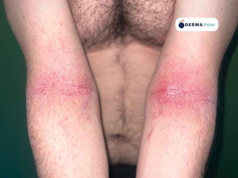 Dermatite atopica con eczema sull'interno delle braccia