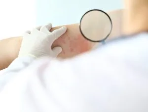 Stare meglio con la dermatite atopica