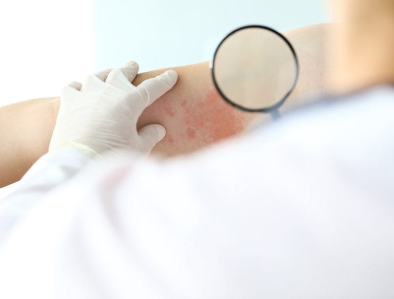 Stare meglio con la dermatite atopica