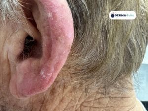 Multiple cheratosi attiniche sull'orecchio