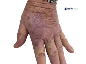 Pregresso carcinoma squamocellulare