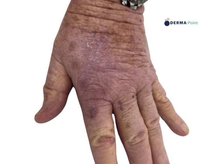 Pregresso carcinoma squamocellulare