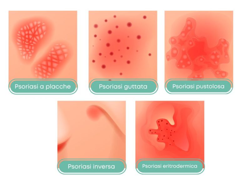 Come capire se è psoriasi