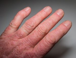 Come si cura l’artrite psoriasica