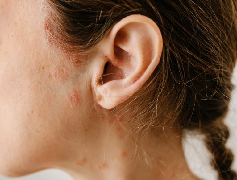 Dermatite atopica orecchie