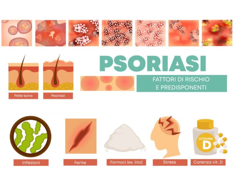 Psoriasi cause
