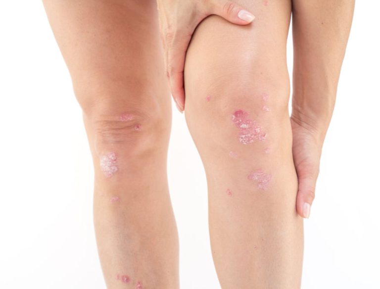Psoriasi alle gambe