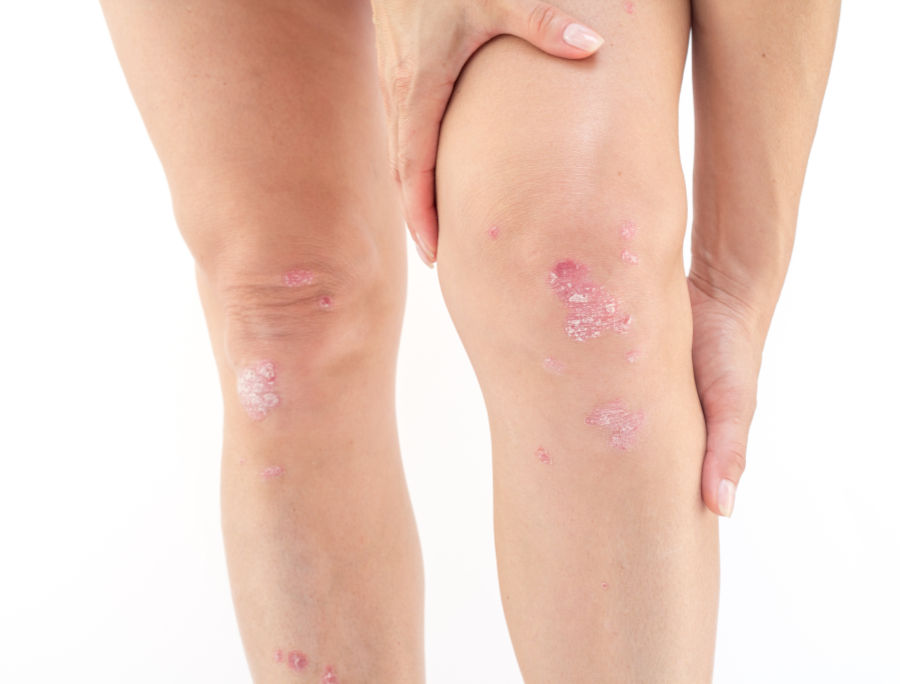 Psoriasi alle gambe