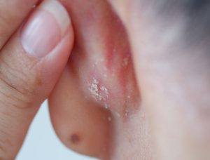 Psoriasi alle orecchie
