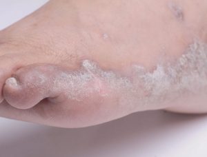 Psoriasi ai piedi