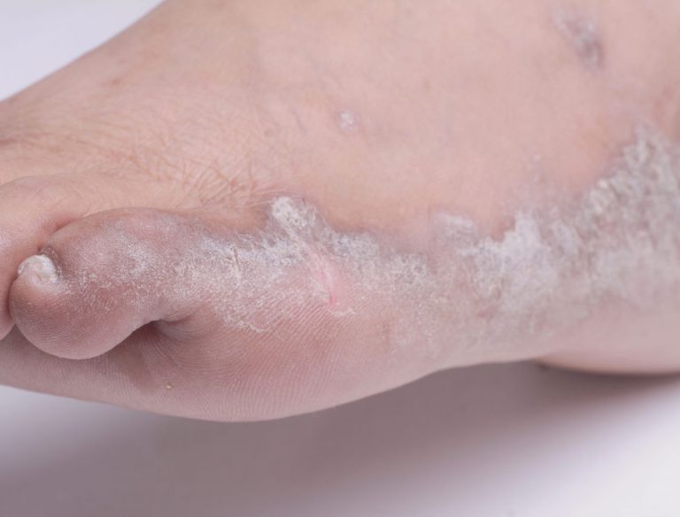 Psoriasi ai piedi