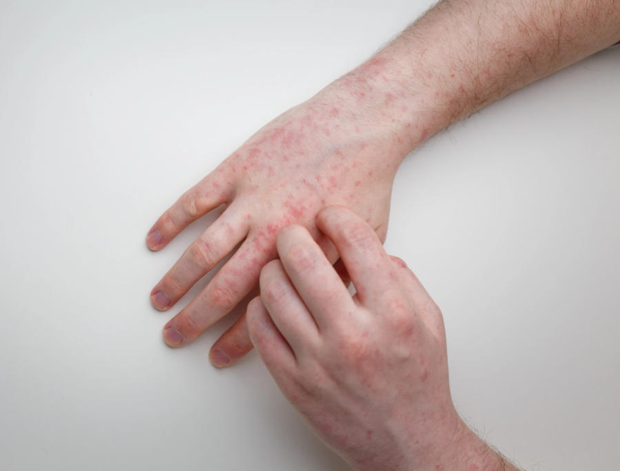 Dermatite atopica cosa non fare
