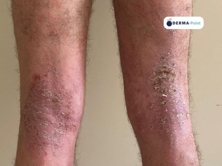 Dermatite atopica desquamazione regioni flessurali