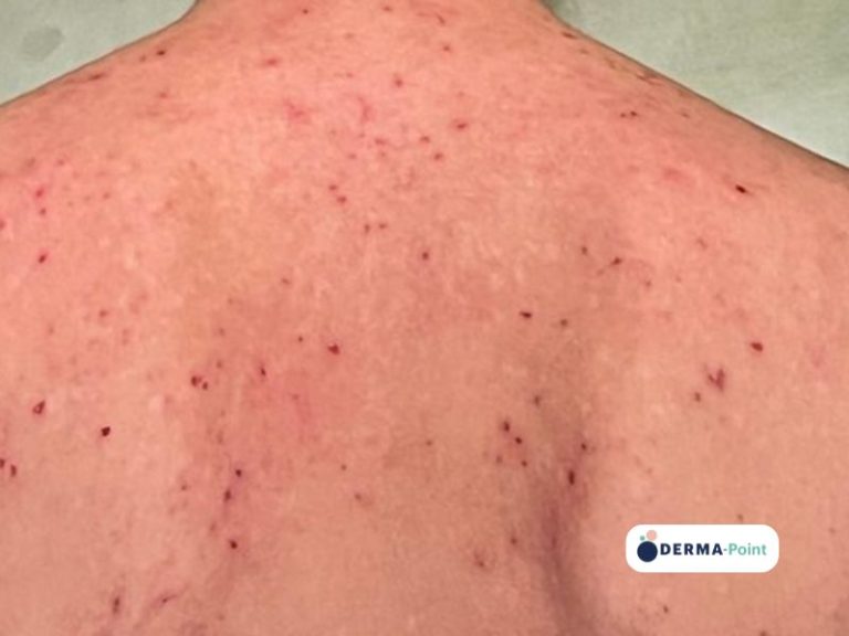 Dermatite atopica prurigo like sul dorso