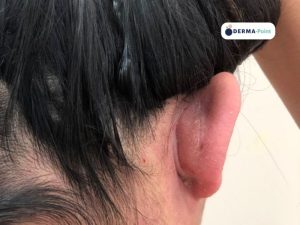 Dermatite atopica regione retroauricolare