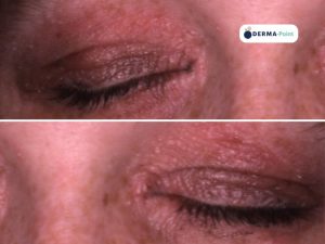 Dermatite atopica superficie palpebrale