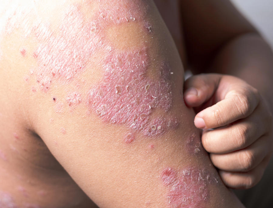 Psoriasi e aspettative di vita