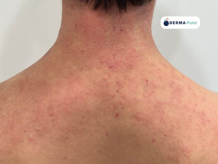 Dermatite atopica sulla regione nucale e dorso superiore