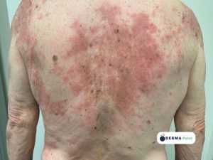 Dermatite atopica con squamo-croste sul dorso