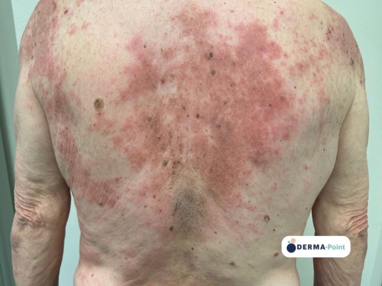 Dermatite atopica con squamo-croste sul dorso