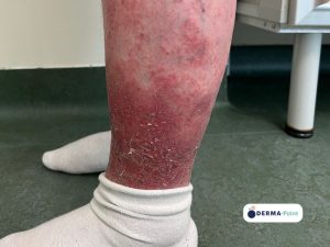 Dermatite atopica con desquamazione lamellare sulle gambe