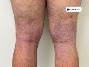 Dermatite atopica sui cavi poplitei