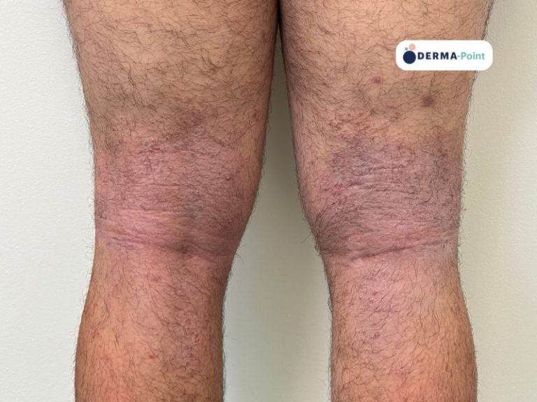 Dermatite atopica sui cavi poplitei