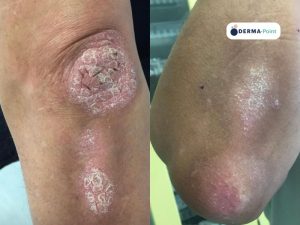 Placche psoriasiche sugli avambracci