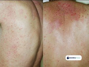 Psoriasi guttata del tronco