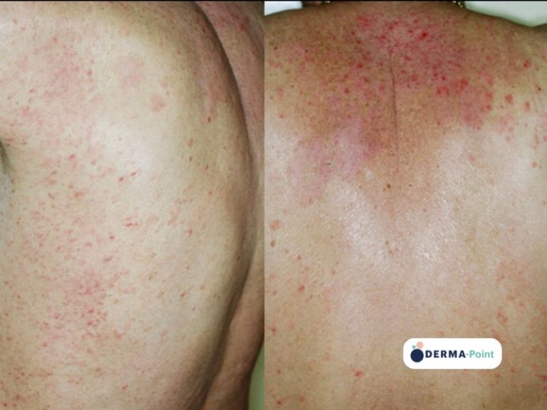 Psoriasi guttata del tronco