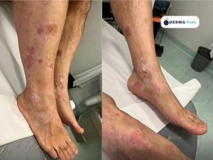 Psoriasi a placche e guttata sulle gambe