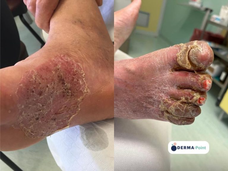 Psoriasi pustolosa ai piedi